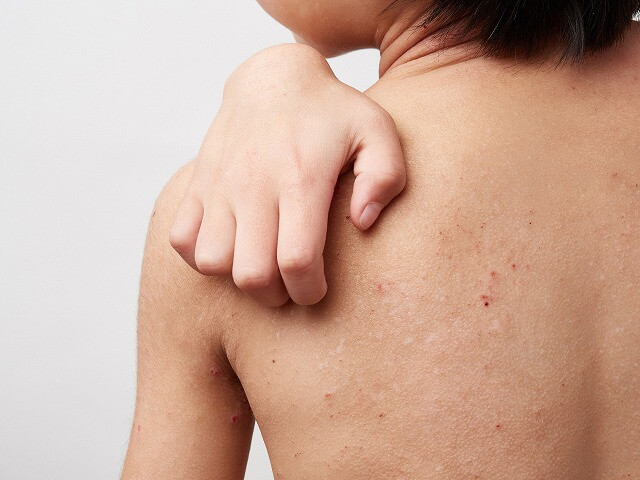 アトピー性皮膚炎の原因や治療法