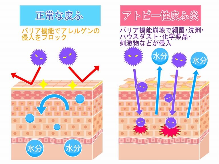 アトピー性皮膚炎の原因