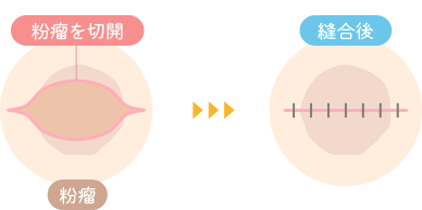 粉瘤・脂肪腫の切開法|枚方市のすわ診療所