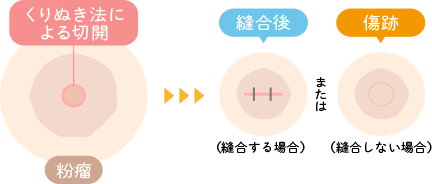 粉瘤・脂肪腫のくり抜き法|枚方市のすわ診療所