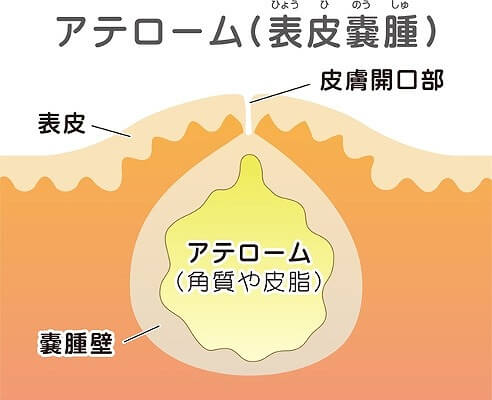 粉瘤|枚方市御殿山駅にある皮膚科、すわ診療所