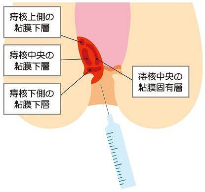 枚方市のすわ診療所では、ジオン注射による切らない痔の日帰り手術に対応