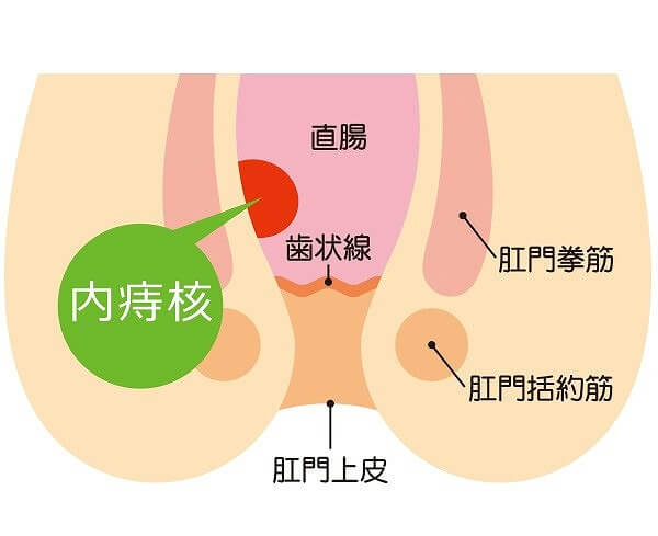 内痔核の手術|枚方市のすわ診療所による痔の日帰り手術1