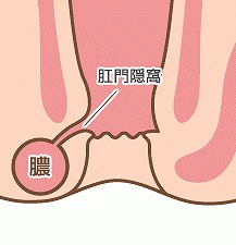 肛門周囲膿瘍|枚方市のすわ診療所による痔の日帰り手術4